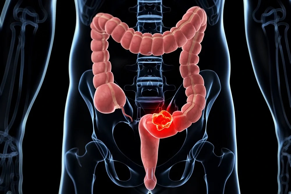 chirurgie colo rectale 1