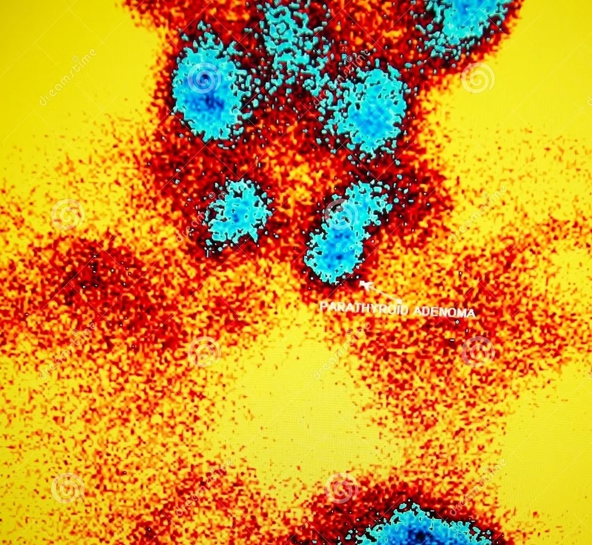 chirurgie de la parathyroïde 3