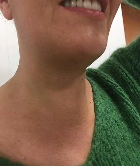 chirurgie de la thyroïde 7