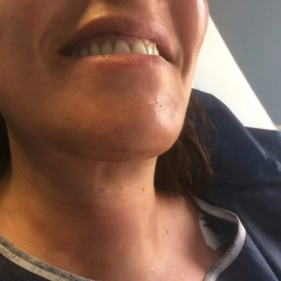 chirurgie de la thyroïde 8