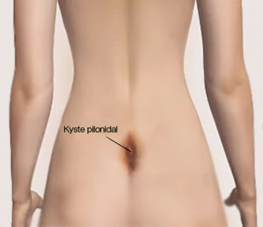 proctologie sinus pilonidal 1