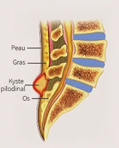 proctologie sinus pilonidal Docteur Deroide Paris