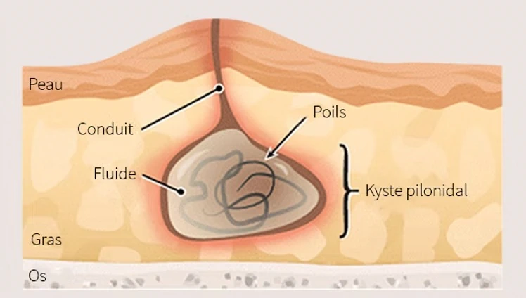 proctologie sinus pilonidal 3