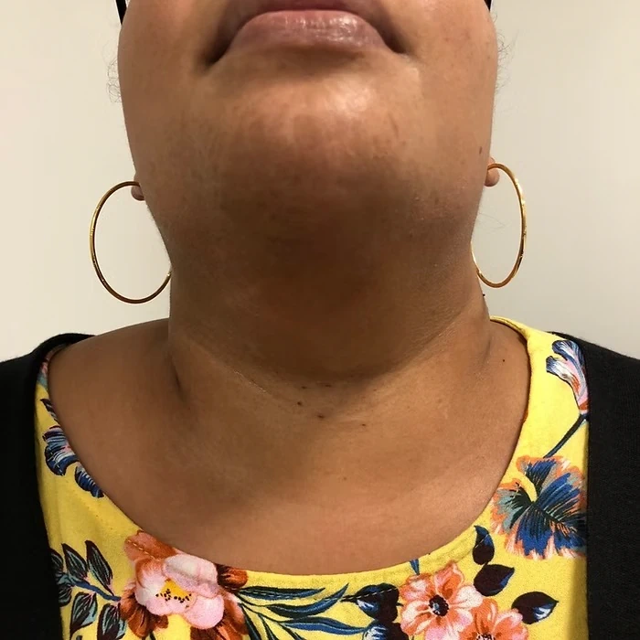 chirurgie de la thyroïde sans cicatrice cervicale 1