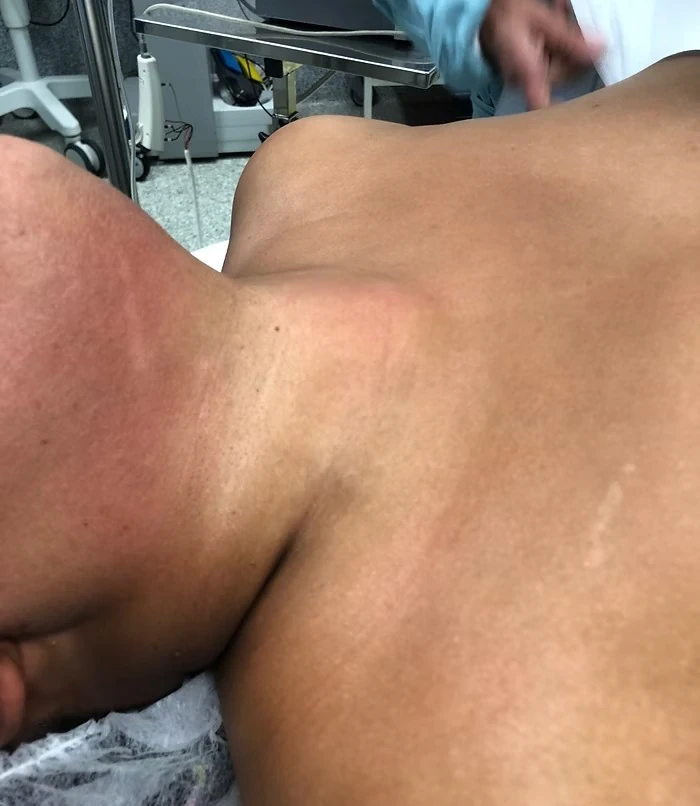 chirurgie de la thyroïde sans cicatrice cervicale 2