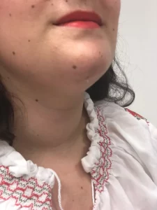 chirurgie de la thyroïde sans cicatrice cervicale 3