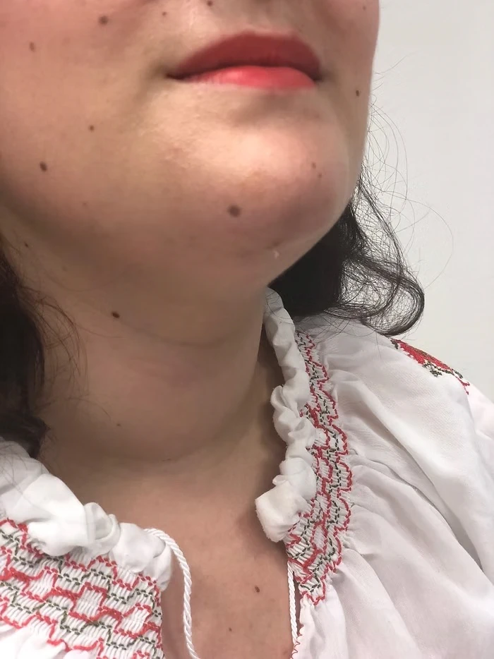 chirurgie de la thyroïde sans cicatrice cervicale 3