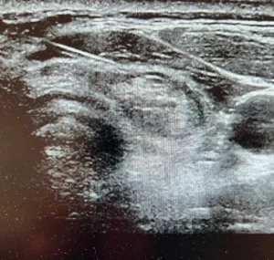 echographie de la thyroide