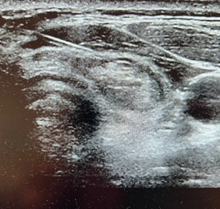 echographie de la thyroide