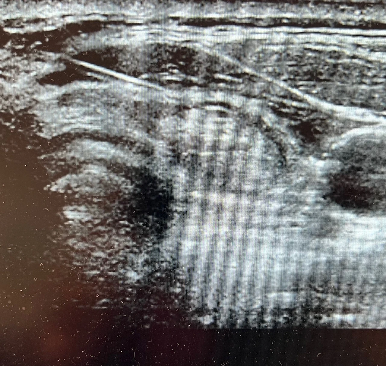 Echographie De La Thyroide echographie de la thyroide