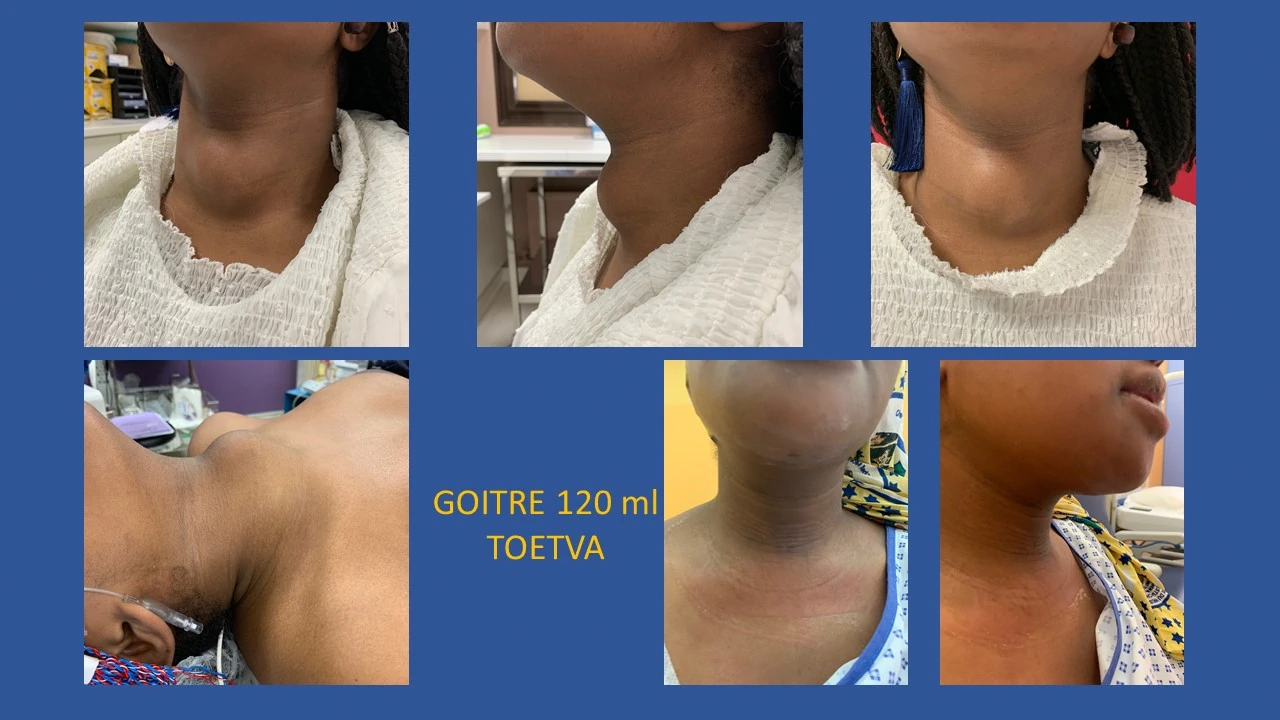 goitre opere sans cicatrice toetva