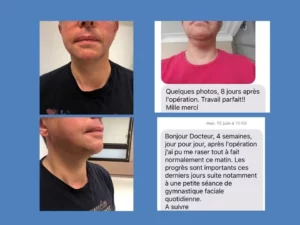 nodule toxique thyroide chirurgie sans cicatrice