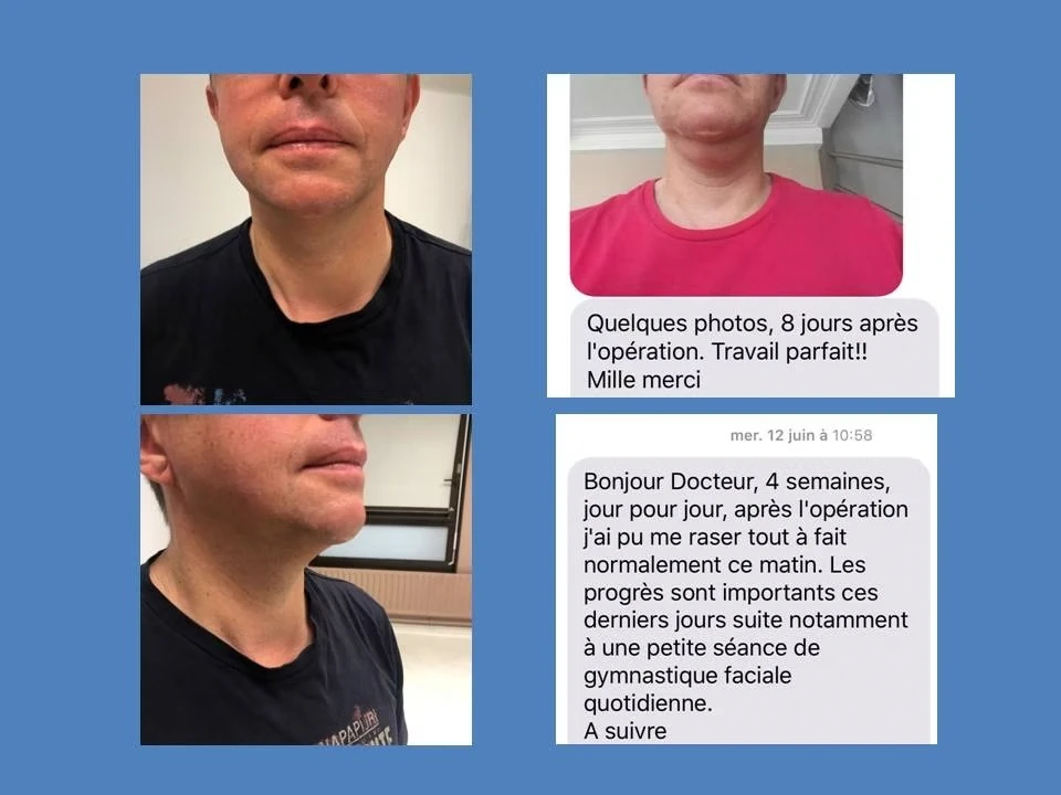Nodule Toxique Thyroide Chirurgie Sans Cicatrice nodule toxique thyroide chirurgie sans cicatrice