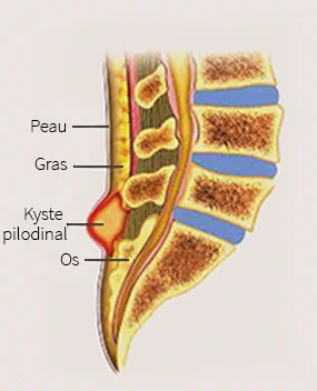 sinus pilonidal comment doit se faire la cicatrisation 2