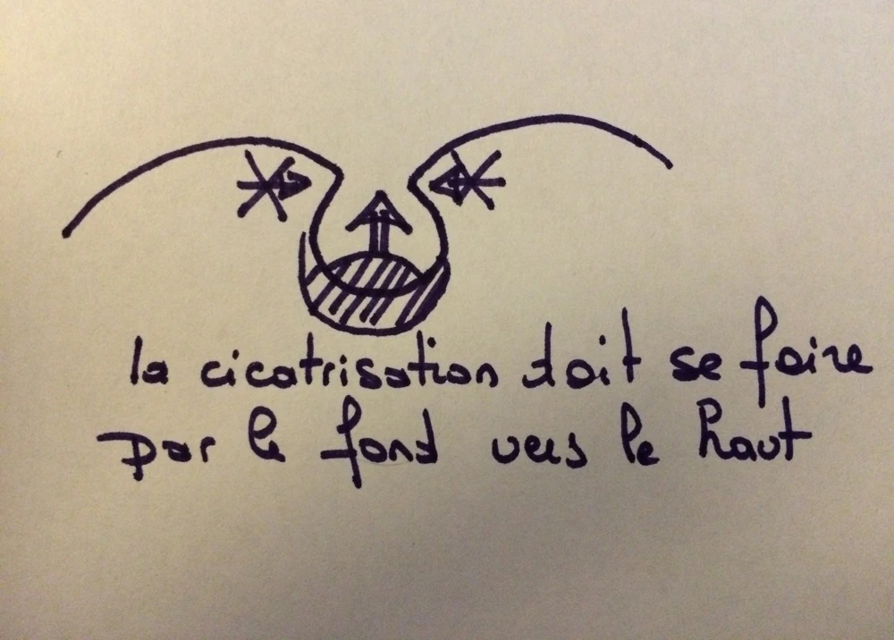 sinus pilonidal comment doit se faire la cicatrisation 3