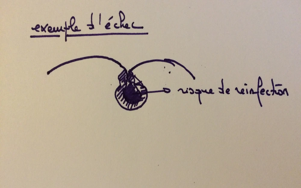 sinus pilonidal comment doit se faire la cicatrisation 4