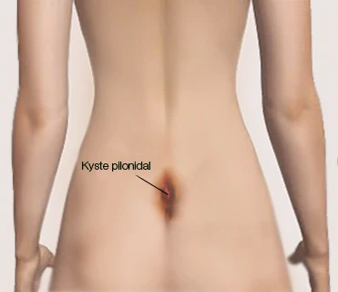 Sinus Pilonidal : Comment doit se faire la cicatrisation sinus pilonidal comment doit se faire la cicatrisation