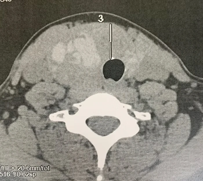 trans oral thyroidectomy vestibular anterior toetva 1