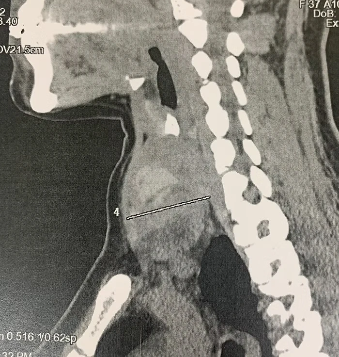 trans oral thyroidectomy vestibular anterior toetva 2