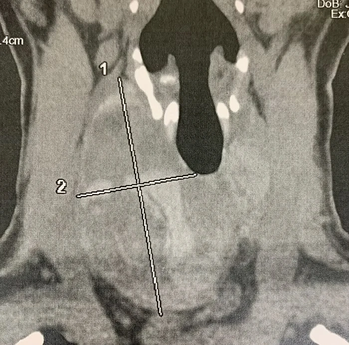 trans oral thyroidectomy vestibular anterior toetva 3