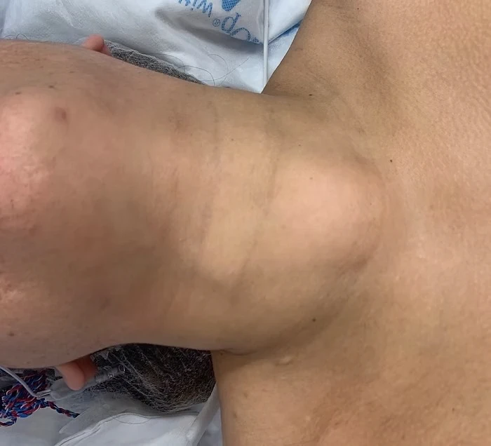 trans oral thyroidectomy vestibular anterior toetva 5