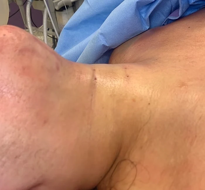 trans oral thyroidectomy vestibular anterior toetva 6