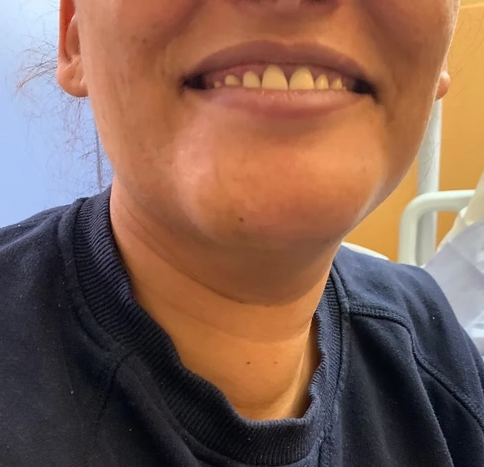 trans oral thyroidectomy vestibular anterior toetva 7