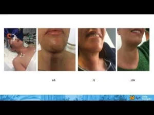 transoral endoscopic thyroidectomy vestibular approach toetva