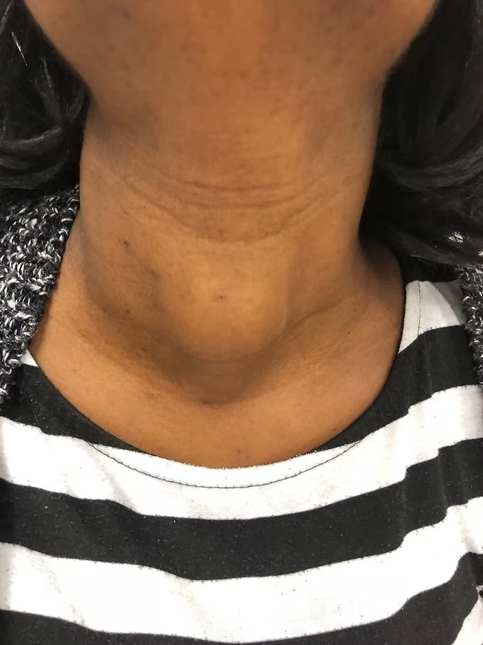 Volumineux Nodule Thyroidien, Chirurgie Endo Buccale Sans Cicatrice Cervicale volumineux nodule thyroidien chirurgie endo buccale sans cicatrice cervicale 1