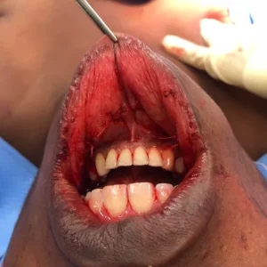 volumineux nodule thyroidien chirurgie endo buccale sans cicatrice cervicale 2