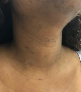 volumineux nodule thyroidien chirurgie endo buccale sans cicatrice cervicale 3